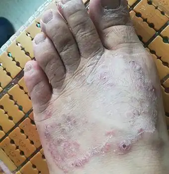 腿部湿疹症状及病因