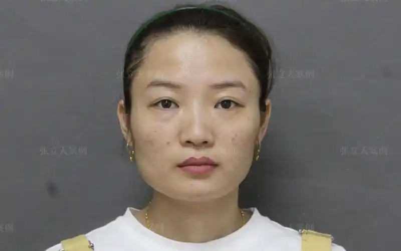 改脸型医生张立天:34岁姑娘,颧骨突 方脸 左右不对称,期待改变!