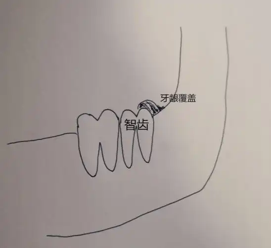 第二磨牙拔了三十年没有补(有些智齿可以不拔,通过正畸或移植保留)