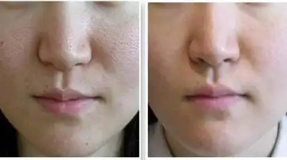 专业美容老师亲身验证海洋诗韵-涂抹式水光针效果