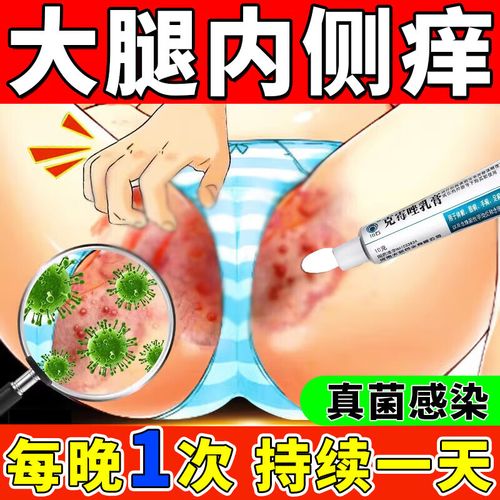 股癣专用药膏大腿内侧阴囊湿疹真菌感染私处瘙痒 体癣 股癣 花斑癣