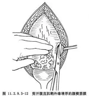 腹膜外剖宫产术