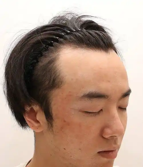 网友称华晨宇是自己老公,还晒出多张华晨宇植发照片,称张碧晨是小三