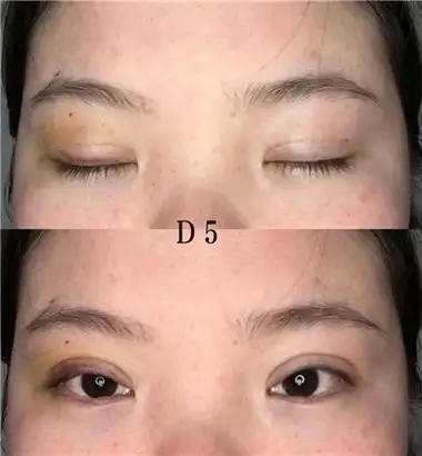 埋线双眼皮失败后如何修复