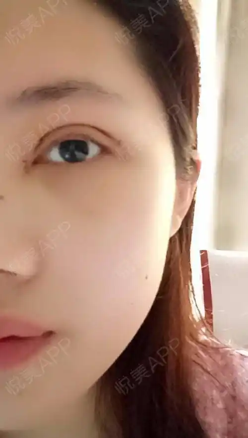 开眼角术后3天_双眼皮术后3天_眼部整形术后3天_美美美少女分享图 11