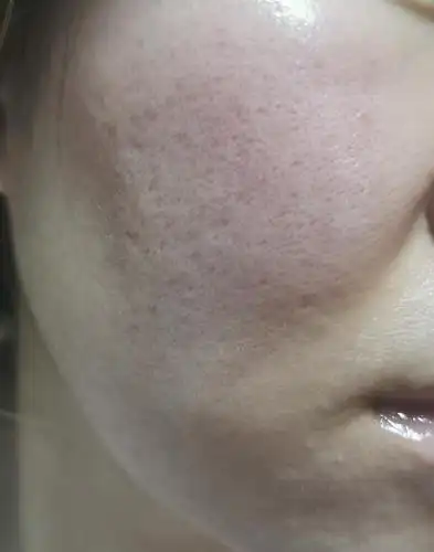 毛孔粗大怎么办