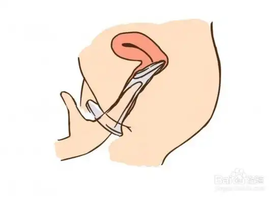 详细图解女式避孕套使用方法