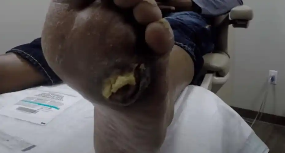 溃烂不愈的糖尿病足,竟然被「恶心」的蛆虫治好了?