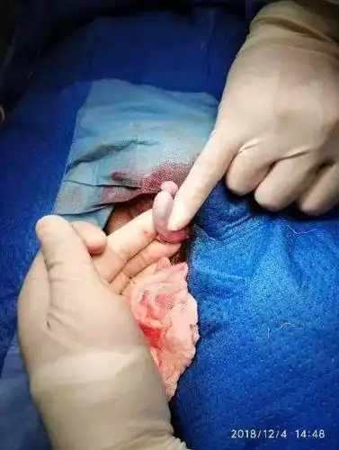 术中发现患者睾丸发育极差,小拇指头大小