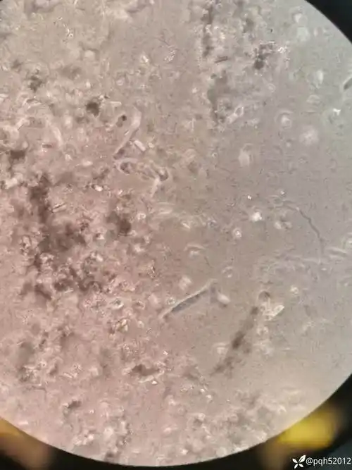 尿液磷酸铵镁结晶图片