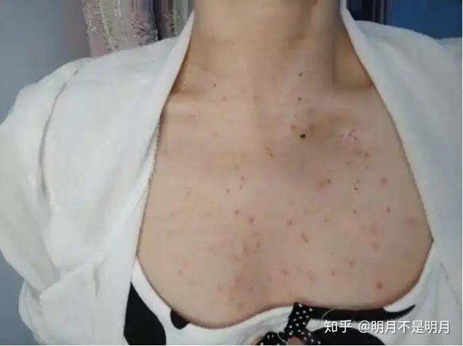 关注问题 67 写回答 青春痘 皮肤病 毛囊炎 痤疮 背肌 后背上长痘