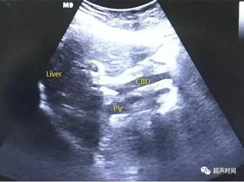 和图   声像图示胆总管(cbd)轻度扩张