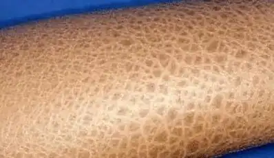 长沙专业治疗鱼鳞病医院,治疗好不好?_鳞屑_多种类型_边缘