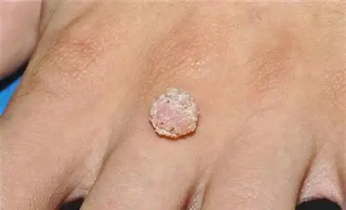 病毒性疣是什么症状