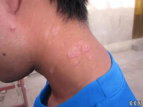 颈部皮疹求助 - 皮肤及性传播疾病讨论版 - 爱爱医医学论坛