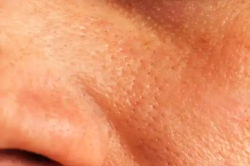 脸部毛孔粗大怎么办毛孔粗大有办法缩小吗