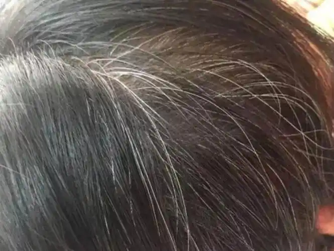 13岁孩子有白头发怎么治疗中学生长白发怎么治疗