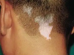 北京市白癜风哪家医院最好:青少年预防白癜风