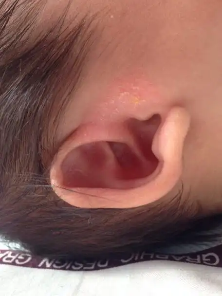 婴儿湿疹引起耳朵流脓怎么办_婴儿湿疹长到耳朵里_宝