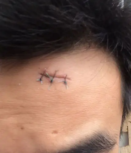 淡蓝色的,缝合12天了,请问还需多久才完全吸收?脱落