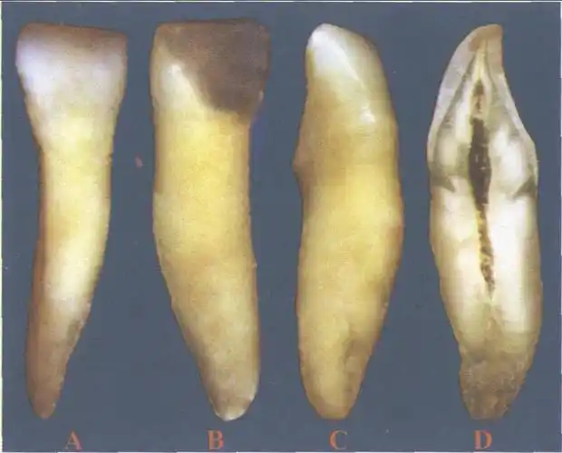 (图) 下颌中切牙