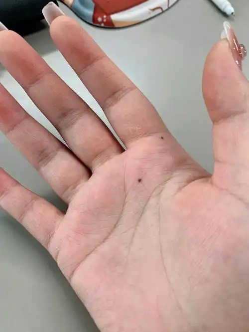手心痣是什么意思