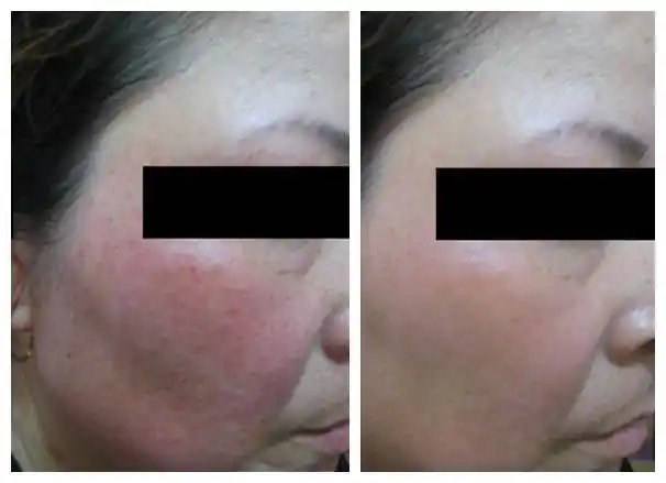 红血丝前后对比