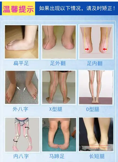 内翻纠正鞋宝宝xo型腿矫正器外八字扁平足春秋运动款网面玫红色量足