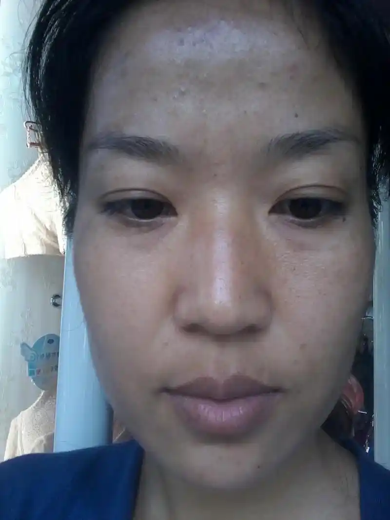 图一33岁,那时候的皮肤状态真的一脸的趣斑一脑门的芬刺,自从 - 抖音