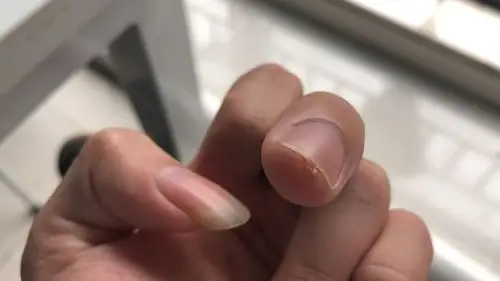 手指之间长了肉刺一样是什么原因,都半年了还没好?