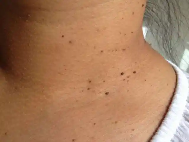 原创脖子上的肉疙瘩不仅影响美观还会癌变医生终于不再隐瞒