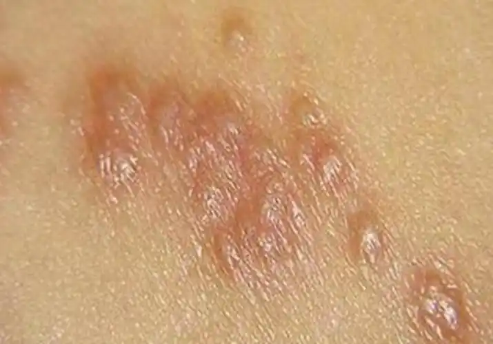 孕妇疥疮初期腹部皮肤症状图片