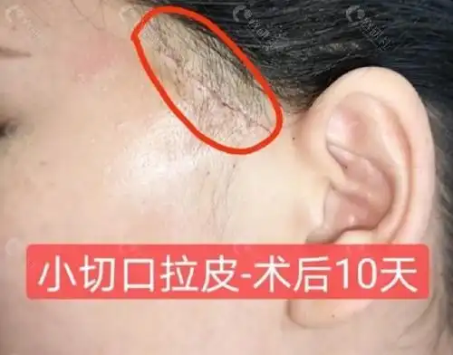 广州陈兵拉皮多少钱花7万做小切口拉皮是交了智商税么