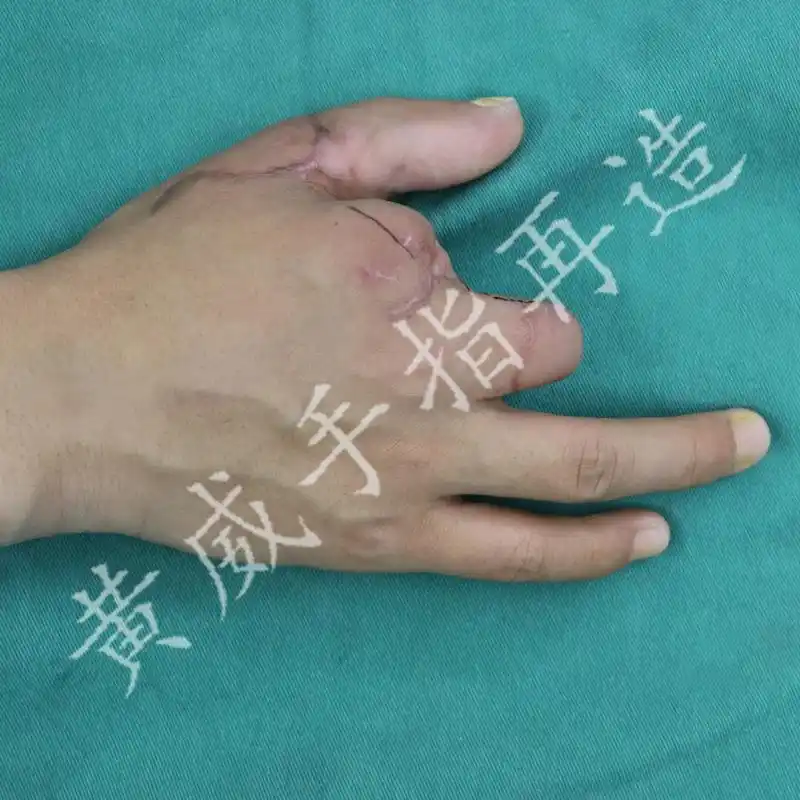 有手指再造术吗?失去的手指可以再造出来吗?