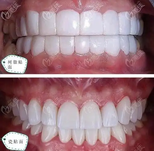 树脂贴面和瓷贴面效果对比图