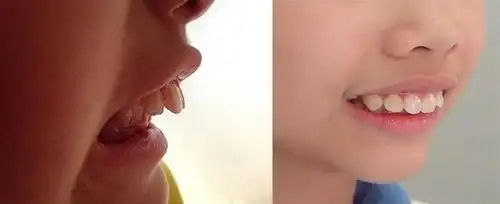 17岁男孩长尖牙,妈妈吐槽像"吸血鬼",网友:被咬一口很难辨别