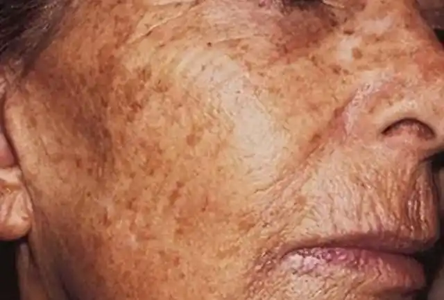 红霉素软膏能去除老人斑吗?医生:请提前了解