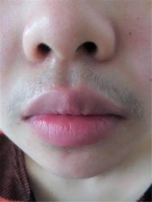 女生"脱唇毛"后,越来越严重?试试这4个办法,有效改善小胡子