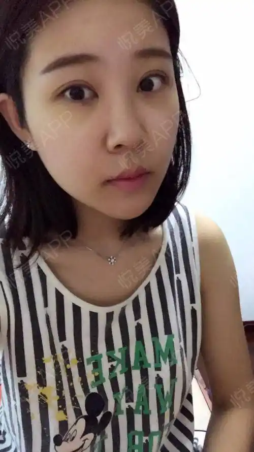 眼睛发黄了,肿么个情况?