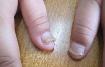 孩子手指长期浸泡在唾液之中,导致皮肤皱起,而指甲则容易出现反翘