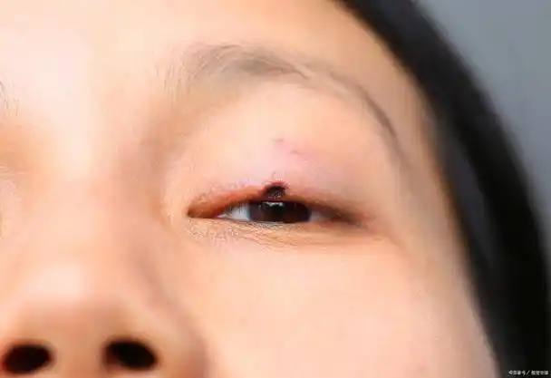 眼睑上出现痣怎么办?有好的去除建议吗?