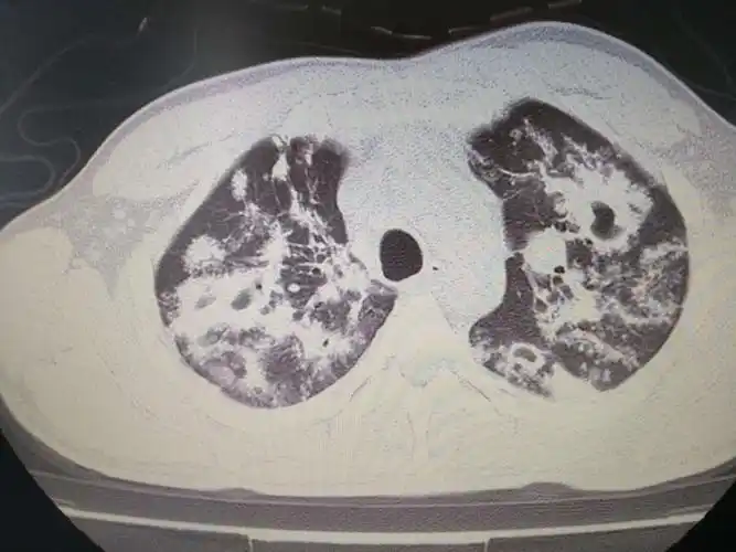 继发性肺结核,32岁,症状逍遥,新书库房工作 - 美篇