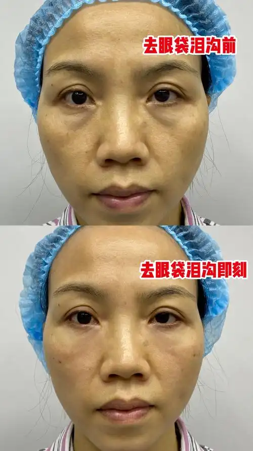 45岁女士做完微创去眼袋 泪沟填充,术后即刻很"惊艳",像变了个人,不敢