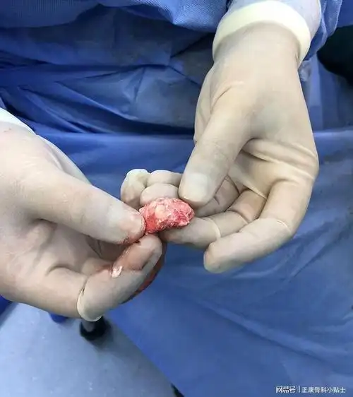 脚趾痛风|急性痛风性关节炎如不及时治疗,关节可能会"结石"