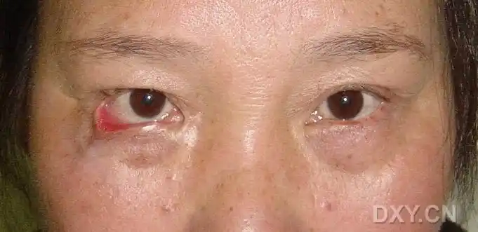 讨论〕也谈外伤性下睑外翻