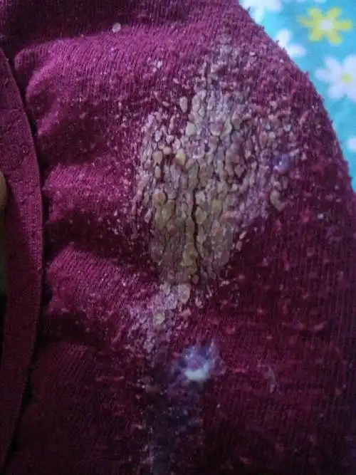 21:00    浏览  33333  满意回答 你的白带是不正常的,这考虑是妇科