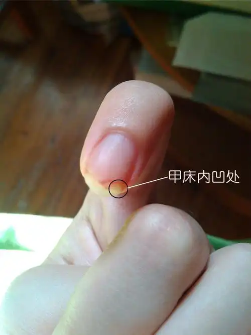 食指指甲劈了后,昨晚洗澡,发现指甲有一小部分甲床脱落到指甲断的地方