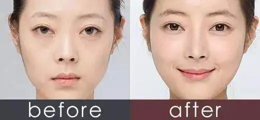 自测你的苹果肌是否需要填充丨科普篇