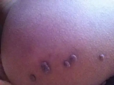 3,引起阴囊内出现小硬疙瘩,常见的疾病如下一附睾囊肿最常见为附睾的