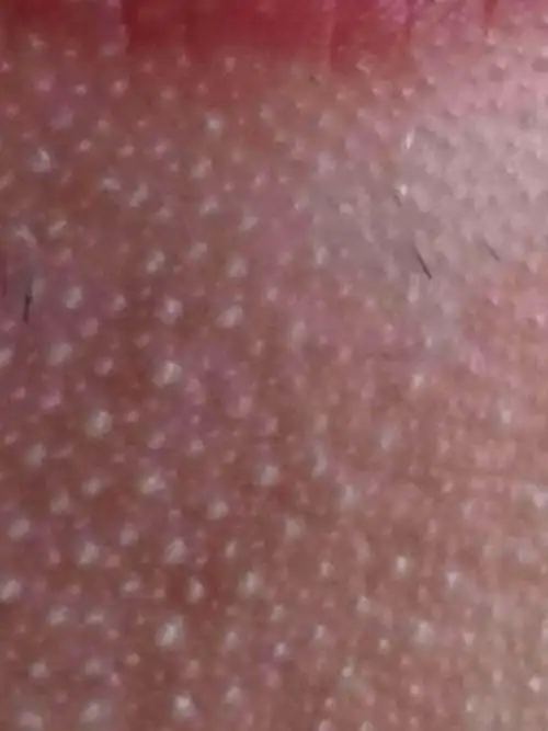 脸上长了很多小颗粒用什么药膏